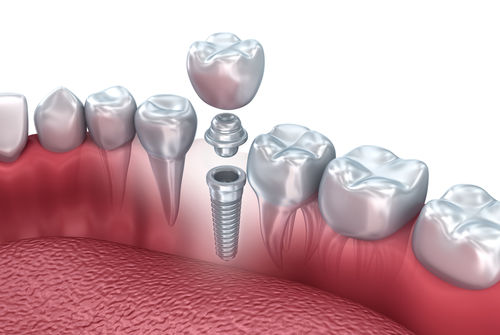 Dental Implants Manassas VA | Dental implant animation.