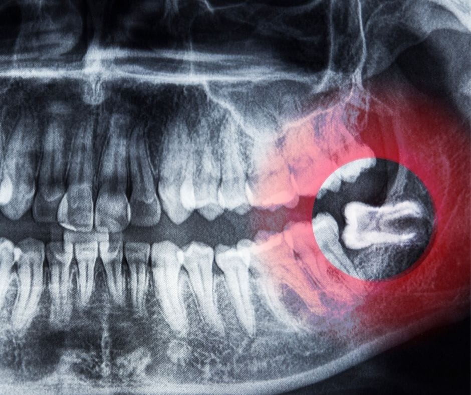 wisdom teeth